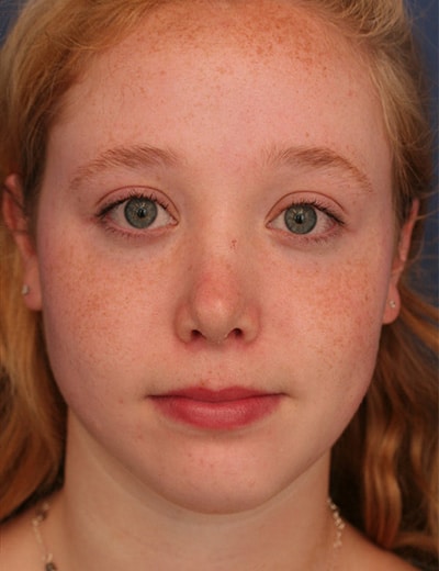 After Image: Rhinoplasty - front