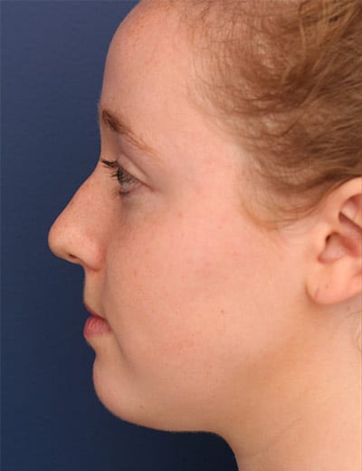 Before Image: Rhinoplasty - left-side