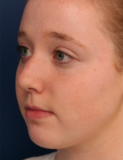 Before Image: Rhinoplasty - left-front-oblique