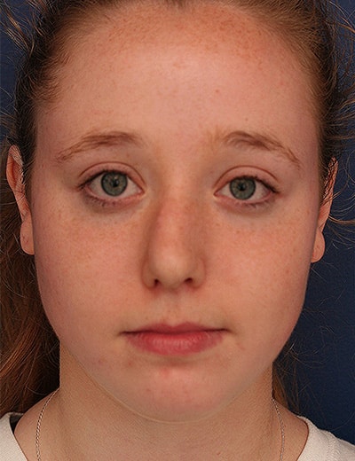 Before Image: Rhinoplasty - front