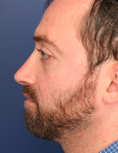 After Image: Rhinoplasty - left-side
