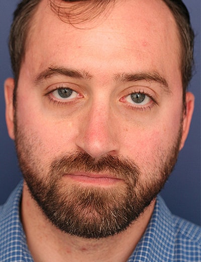 After Image: Rhinoplasty - front