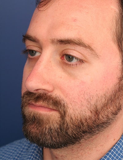 After Image: Rhinoplasty - left-front-oblique
