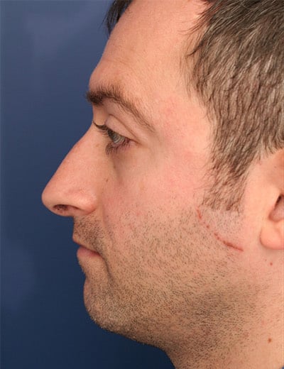 Before Image: Rhinoplasty - left-side