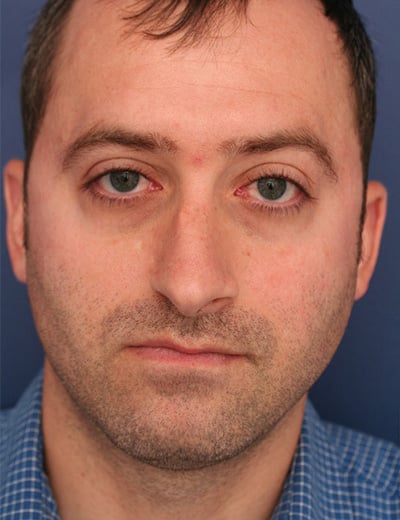Before Image: Rhinoplasty - front