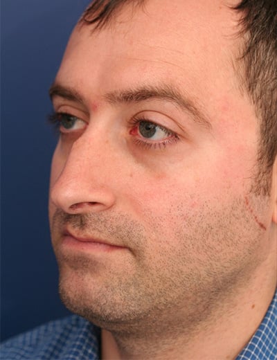 Before Image: Rhinoplasty - left-front-oblique