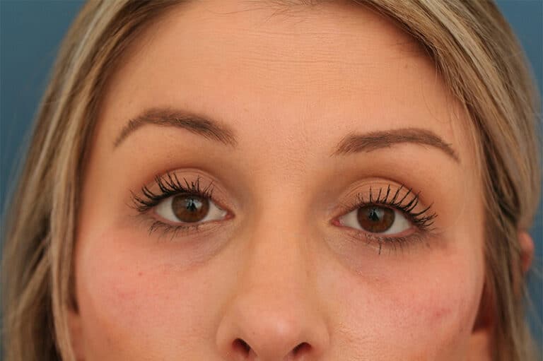 Before Image: Tear Trough – Refyne - front