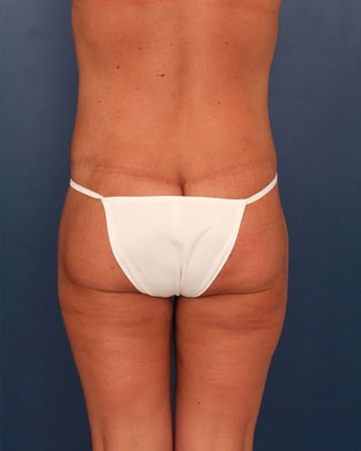 After Image: Tummy Tuck - back