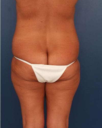 Before Image: Tummy Tuck - back