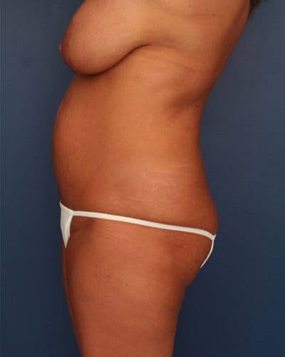 Before Image: Tummy Tuck - left-side