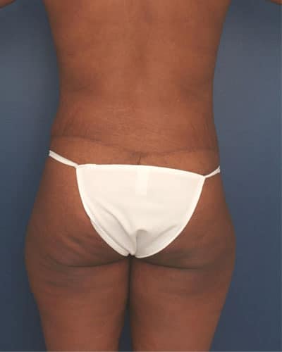 After Image: Tummy Tuck - back