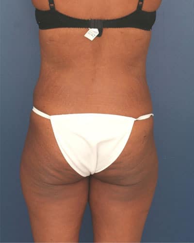 Before Image: Tummy Tuck - back