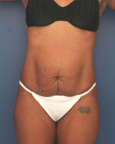 Before Image: Tummy Tuck - front