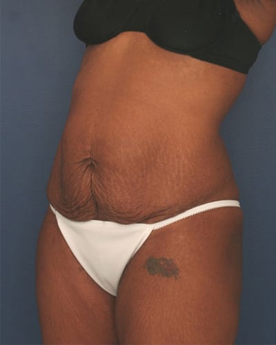 Before Image: Tummy Tuck - left-front-oblique