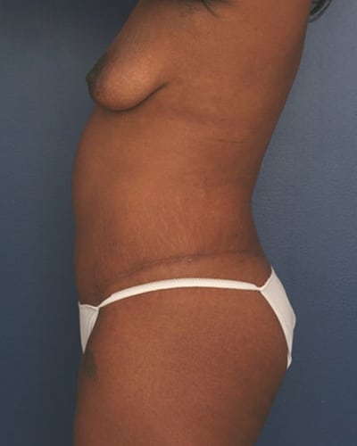 After Image: Tummy Tuck - left-side