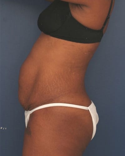 Before Image: Tummy Tuck - left-side