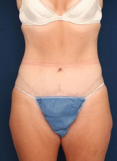 After Image: Tummy Tuck - front