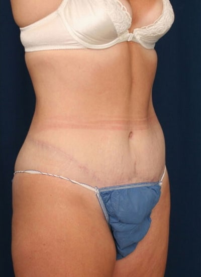 After Image: Tummy Tuck - right-front-oblique