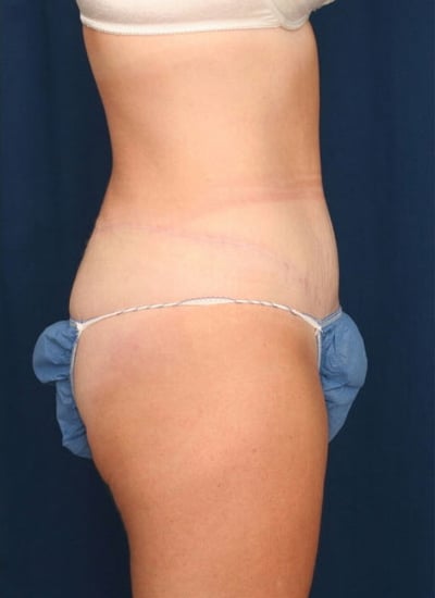 After Image: Tummy Tuck - right-side