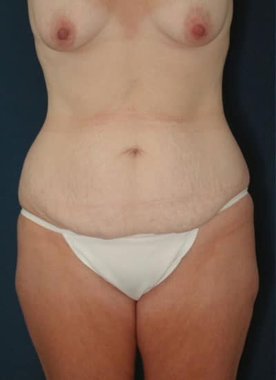 Before Image: Tummy Tuck - front