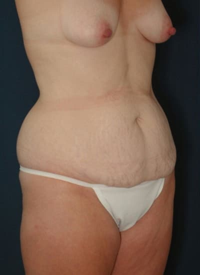 Before Image: Tummy Tuck - right-front-oblique