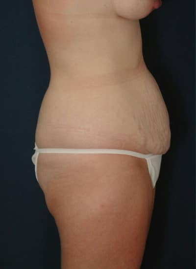 Before Image: Tummy Tuck - right-side