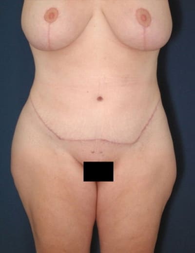 After Image: Tummy Tuck - front