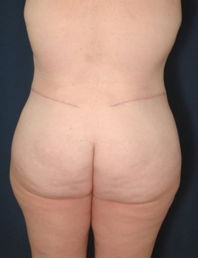 After Image: Tummy Tuck - back