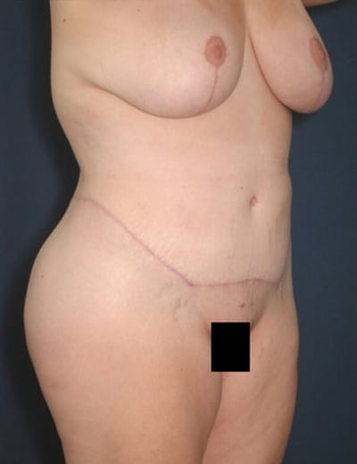 After Image: Tummy Tuck - right-front-oblique