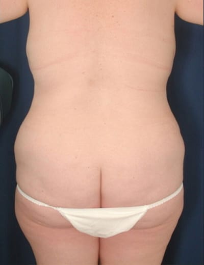 Before Image: Tummy Tuck - back