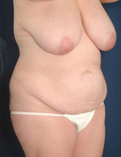 Before Image: Tummy Tuck - right-front-oblique