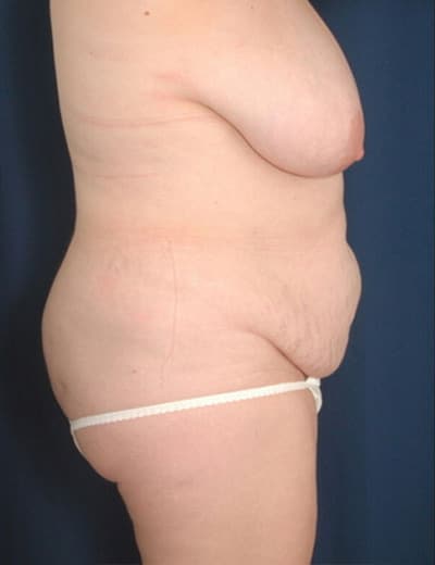 Before Image: Tummy Tuck - right-side