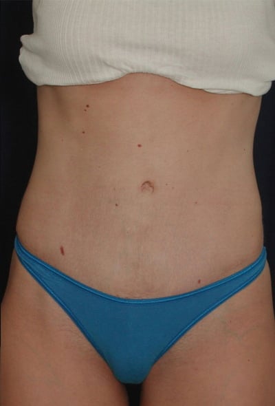 After Image: Tummy Tuck - front