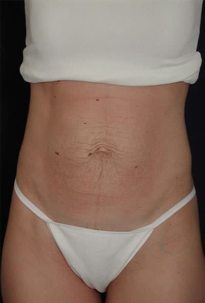 Before Image: Tummy Tuck - front