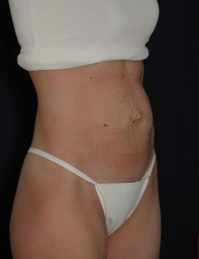 Before Image: Tummy Tuck - right-front-oblique