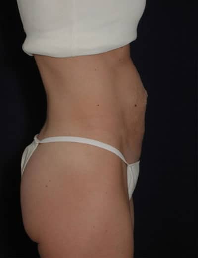 Before Image: Tummy Tuck - right-side