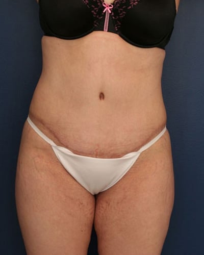 After Image: Tummy Tuck - front