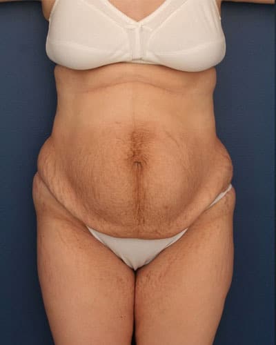 Before Image: Tummy Tuck - front