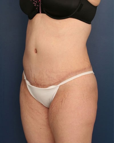 After Image: Tummy Tuck - left-front-oblique