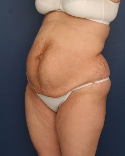 Before Image: Tummy Tuck - left-front-oblique
