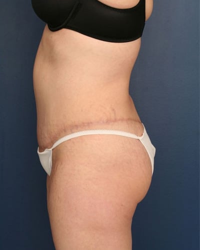 After Image: Tummy Tuck - left-side