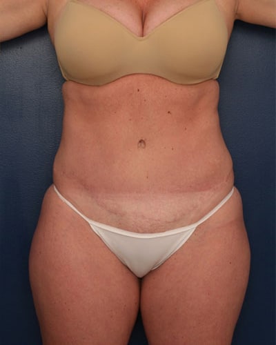 After Image: Tummy Tuck - front