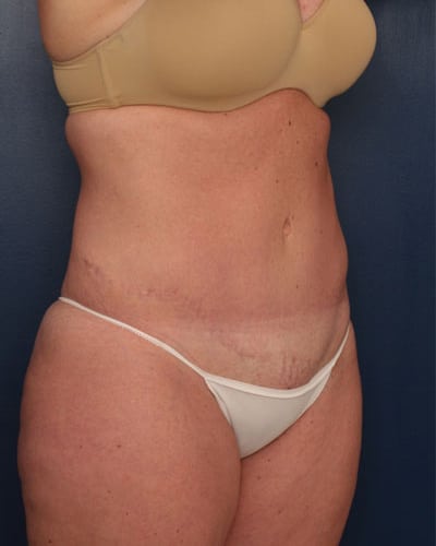 After Image: Tummy Tuck - right-front-oblique