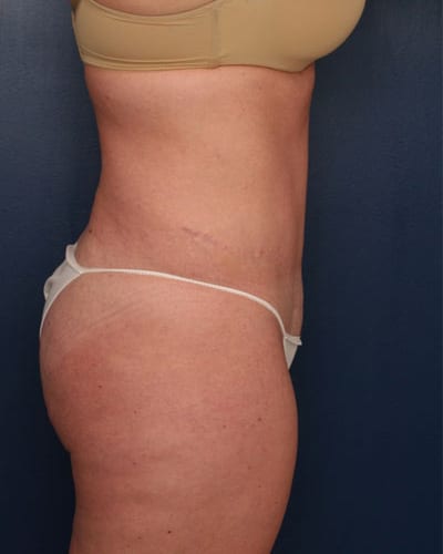 After Image: Tummy Tuck - right-side