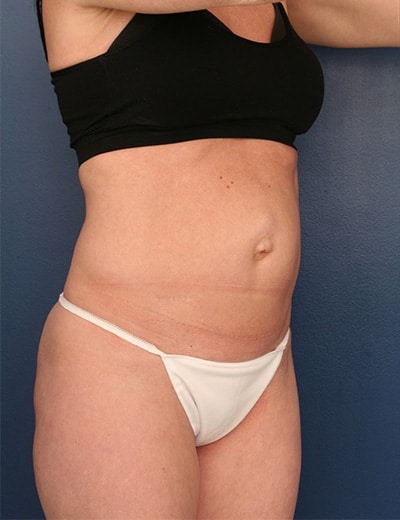 Before Image: Tummy Tuck - right-front-oblique