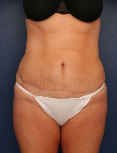 After Image: Tummy Tuck - front