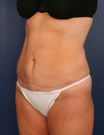 After Image: Tummy Tuck - left-front-oblique