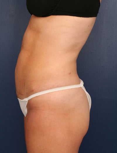After Image: Tummy Tuck - left-side