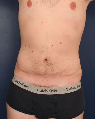 After Image: Tummy Tuck - front