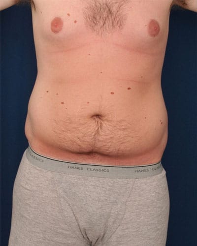 Before Image: Tummy Tuck - front
